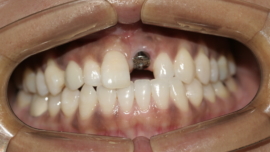 Implant Crown Before